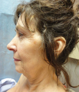 Facelift Before and After Pictures Nashville, TN