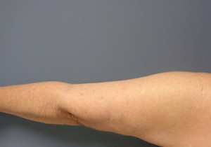 Arm Lift Before and After Pictures Nashville, TN