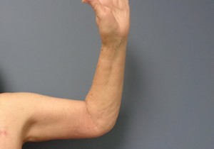 Arm Lift Before and After Pictures Nashville, TN