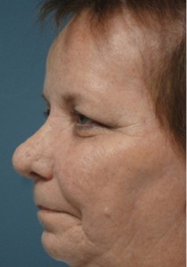Rhinoplasty Before and After Pictures Nashville, TN
