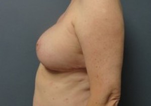 Implant Based Reconstruction Before and After Pictures Nashville, TN