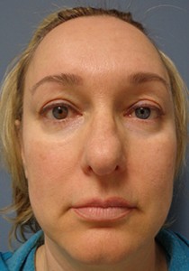 Rhinoplasty Before and After Pictures Nashville, TN
