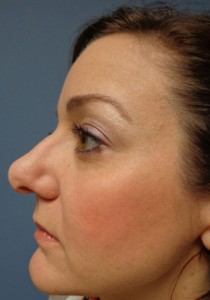 Rhinoplasty Before and After Pictures Nashville, TN