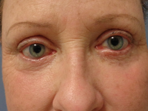 Blepharoplasty Before and After Pictures Nashville, TN