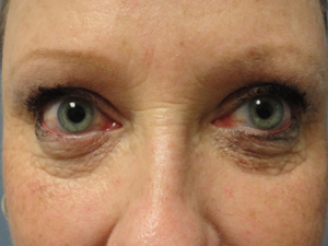 Blepharoplasty Before and After Pictures Nashville, TN