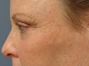 Blepharoplasty Before and After Pictures Nashville, TN