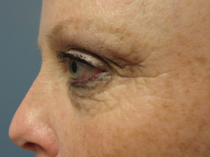 Blepharoplasty Before and After Pictures Nashville, TN