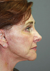 Facelift Before and After Pictures Nashville, TN