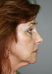 Facelift Before and After Pictures Nashville, TN
