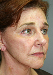 Facelift Before and After Pictures Nashville, TN