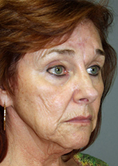 Facelift Before and After Pictures Nashville, TN