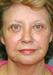 Facelift Before and After Pictures Nashville, TN