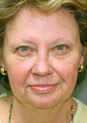 Facelift Before and After Pictures Nashville, TN