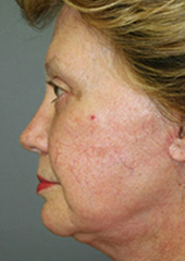 Facelift Before and After Pictures Nashville, TN