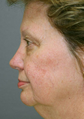 Facelift Before and After Pictures Nashville, TN