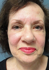 Facelift Before and After Pictures Nashville, TN