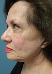 Facelift Before and After Pictures Nashville, TN