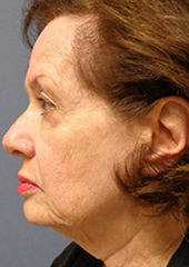 Facelift Before and After Pictures Nashville, TN