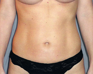 Liposuction Before and After Pictures Nashville, TN