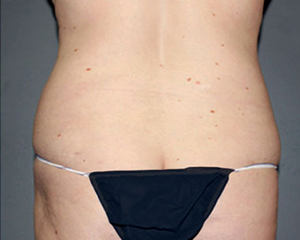 Liposuction Before and After Pictures Nashville, TN