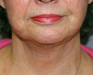 Neck Lift Before and After Pictures Nashville, TN