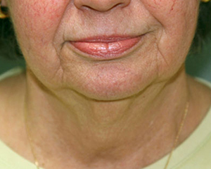 Neck Lift Before and After Pictures Nashville, TN