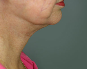 Neck Lift Before and After Pictures Nashville, TN