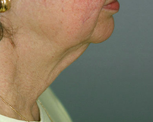 Neck Lift Before and After Pictures Nashville, TN