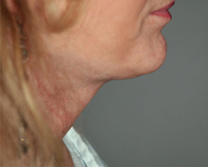 Neck Lift Before and After Pictures Nashville, TN