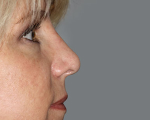 Rhinoplasty Before and After Pictures Nashville, TN