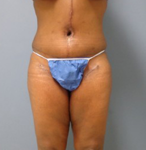 Thigh Lift Before and After Pictures Nashville, TN