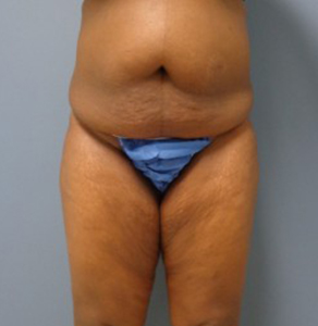 Thigh Lift Before and After Pictures Nashville, TN