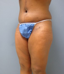 Thigh Lift Before and After Pictures Nashville, TN