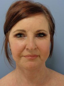 Facelift Before and After Pictures Nashville, TN