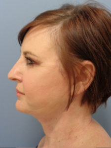 Facelift Before and After Pictures Nashville, TN