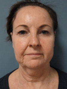 Facelift Before and After Pictures Nashville, TN