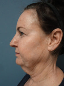 Facelift Before and After Pictures Nashville, TN