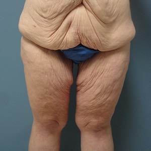 Tighten skin hotsell inner thighs