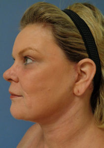 Facelift Before and After Pictures Nashville, TN