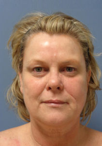 Facelift Before and After Pictures Nashville, TN