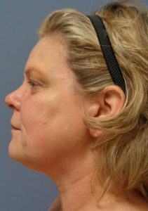 Facelift Before and After Pictures Nashville, TN