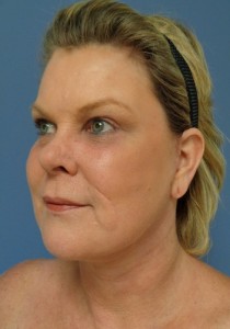 Facelift Before and After Pictures Nashville, TN