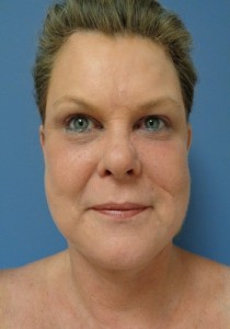 Facelift Before and After Pictures Nashville, TN