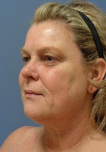 Facelift Before and After Pictures Nashville, TN