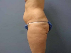 Tummy Tuck Before and After Pictures Nashville, TN