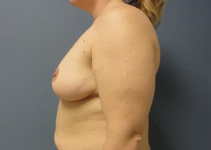 Breast Augmentation with Mastopexy Before and After Pictures Nashville, TN