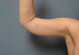 Arm Lift Before and After Pictures Nashville, TN