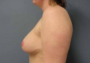 Breast Augmentation with Lift Before and After Pictures Nashville, TN