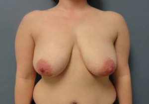 Breast Augmentation with Lift Before and After Pictures Nashville, TN