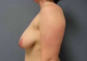 Breast Augmentation with Lift Before and After Pictures Nashville, TN